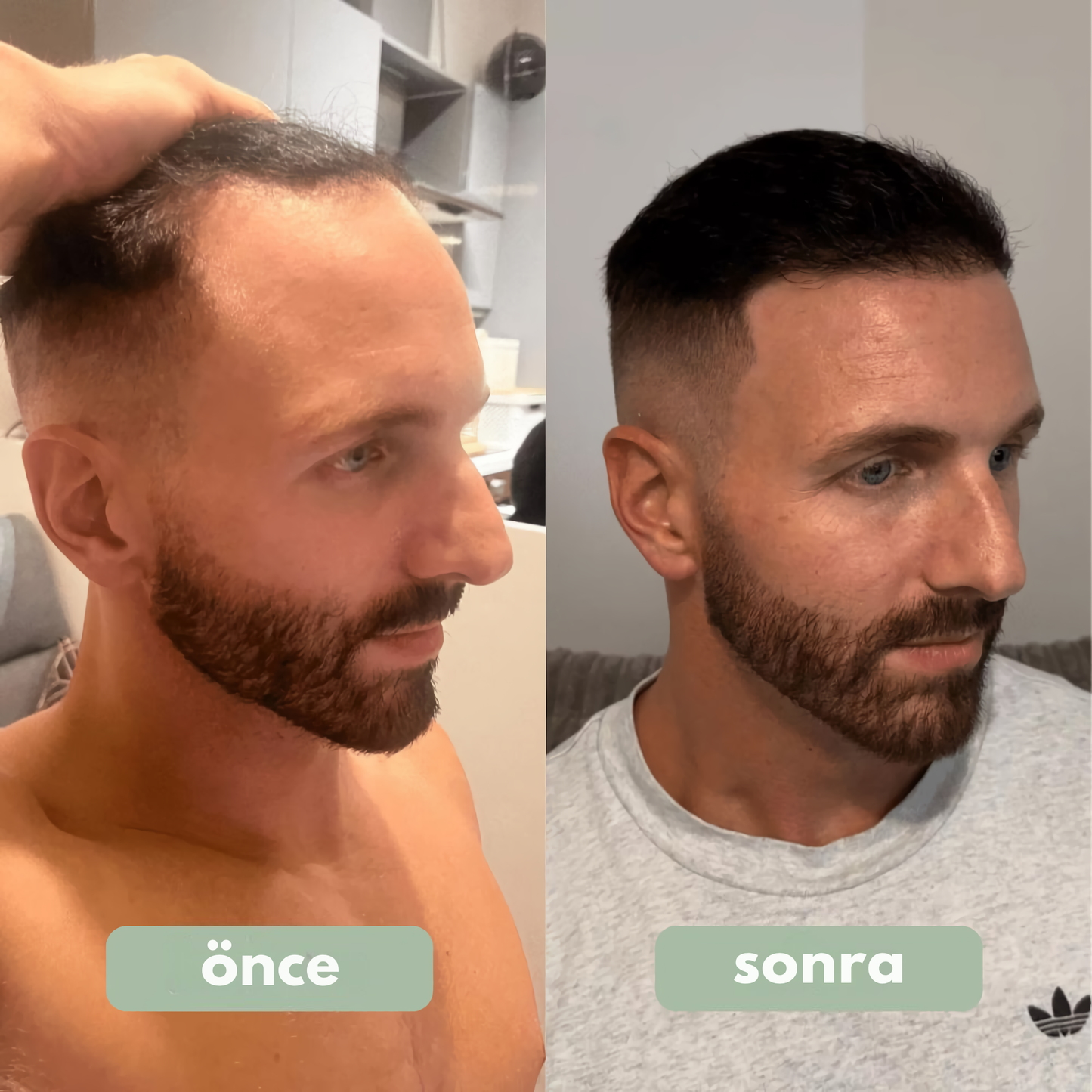 Luverin - Saç Büyüme Serumu